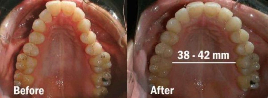 Before and after palate expansion — 38mm to 42mm